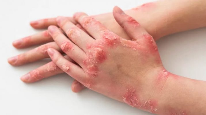 Mengenal 3 Vaksin Andalan WHO untuk Tangkal Penyebaran Mpox