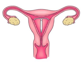 Kontrasepsi Jangka Panjang, Ini Penjelasannya