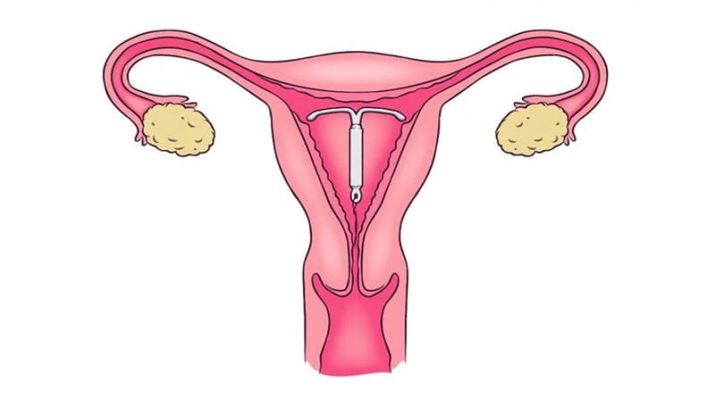 Kontrasepsi Jangka Panjang, Ini Penjelasannya