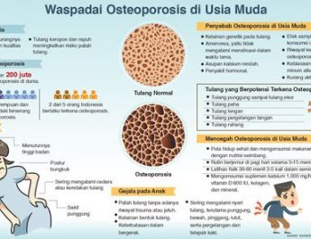 Waspadai Osteoporosis di Usia Muda