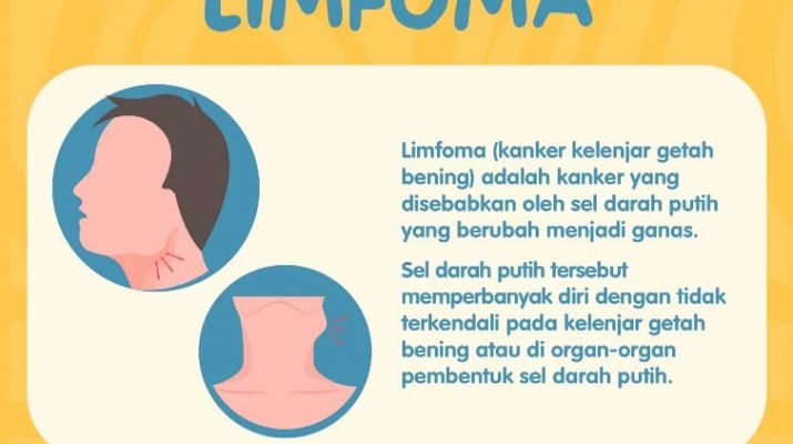 Muncul Benjolan di Area Kelenjar Getah Bening, Waspada Penyakit Limfoma Hodgkin