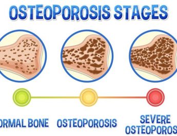 Osteoporosis: Pencuri Diam-Diam yang Mengancam Kesehatan Tulang, Kenali Gejala dan Pencegahannya