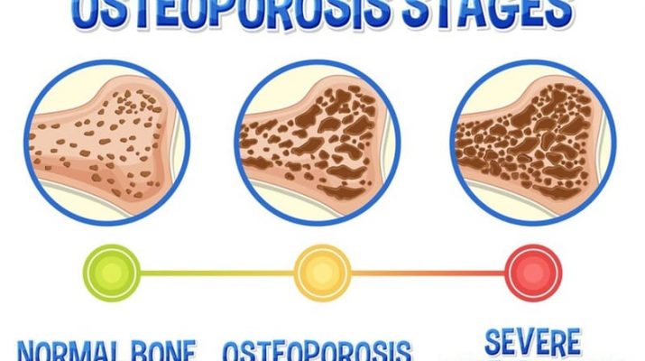 Osteoporosis: Pencuri Diam-Diam yang Mengancam Kesehatan Tulang, Kenali Gejala dan Pencegahannya