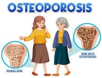 Terkena Osteoporosis? Ini yang Harus Dilakukan