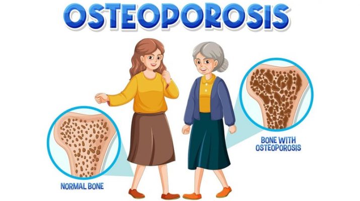 Terkena Osteoporosis? Ini yang Harus Dilakukan