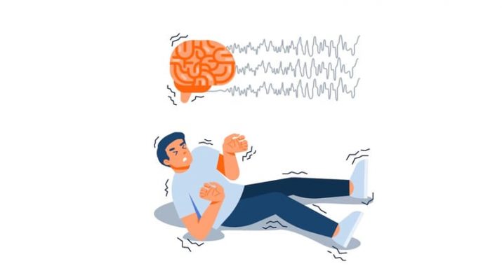 Vagus Nerve Stimulation, Solusi Modern Atasi Epilepsi