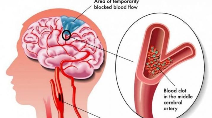 Penanganan Strok Perihal Kecepatan Waktu