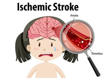 Stroke Iskemik: Penyebab, Gejala, Penanganan, dan Langkah Pencegahannya