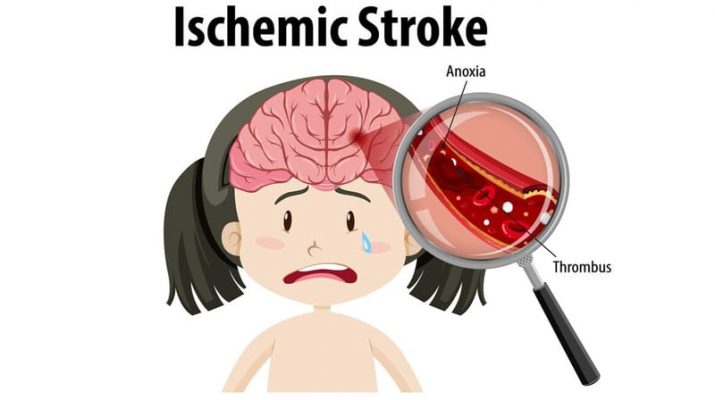 Stroke Iskemik: Penyebab, Gejala, Penanganan, dan Langkah Pencegahannya