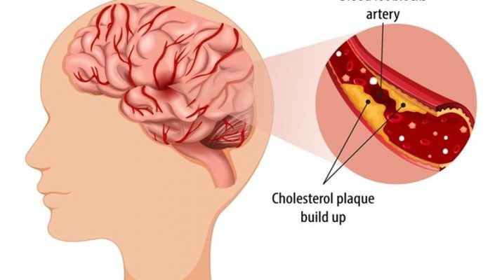 Mengenal Stroke Trombotik: Penyebab, Gejala, dan Cara Pencegahan