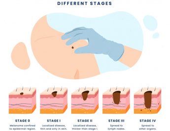 Gejala Tidak Nampak, Cegah Tumor Kulit Sedini Mungkin