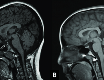 Penyakit Langka, Empty Sella Syndrome Jarang Picu Gejala