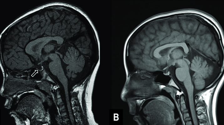 Penyakit Langka, Empty Sella Syndrome Jarang Picu Gejala