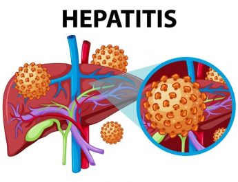 Kenali Gejala Hepatitis A dan Cara Mencegahnya