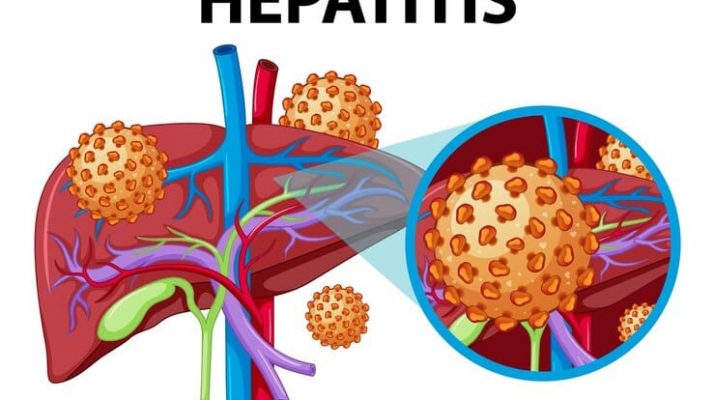 Kenali Gejala Hepatitis A dan Cara Mencegahnya