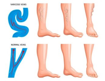 Ini Penyebab Varises Banyak Dialami Perempuan