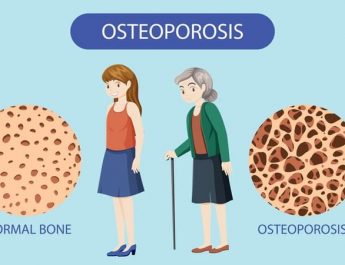 Perempuan Berisiko Osteoporosis, Cek dengan Pemeriksaaan Kepadatan Mineral Tulang