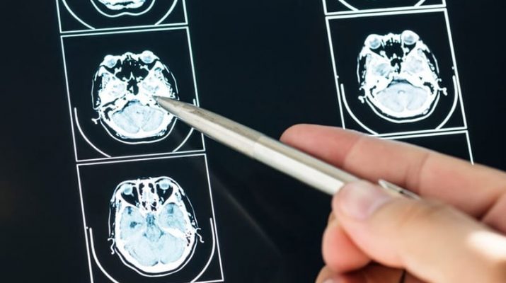 Hari Stroke Sedunia: Meningkatkan Kesadaran Global untuk Pencegahan dan Penanganan Stroke