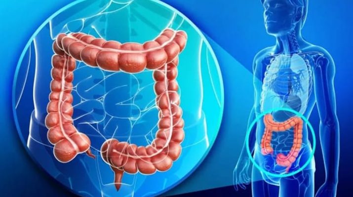 Deteksi Kanker Usus dengan Virtual Colonoscopy, Nyaman dan Cepat